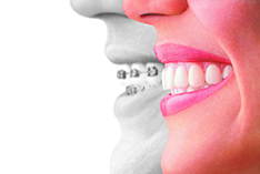 Invisalign® Treatment - Dr. George Orthodontics